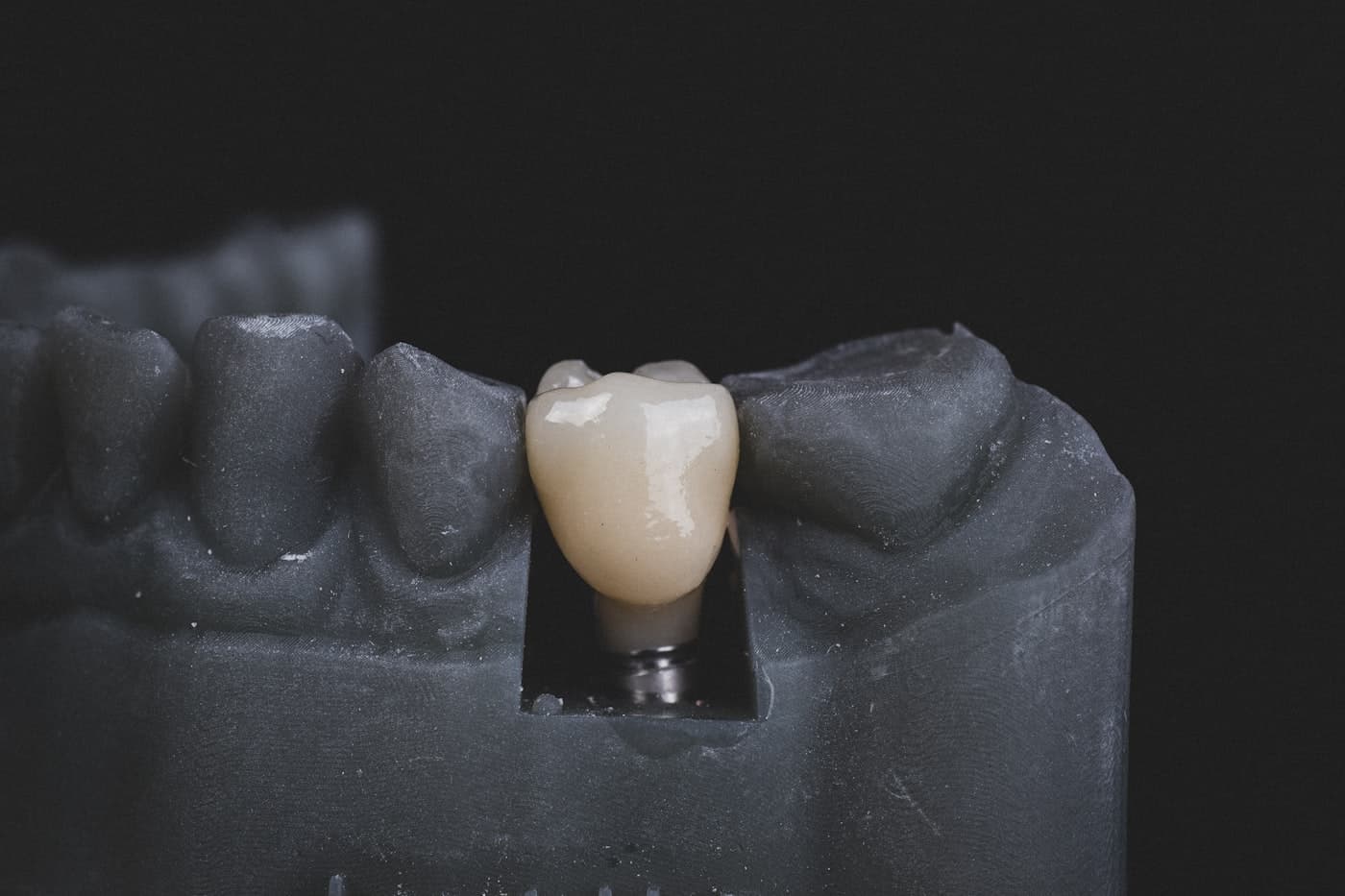 Are Dental Implants Worth It? Weighing Cost vs. Value