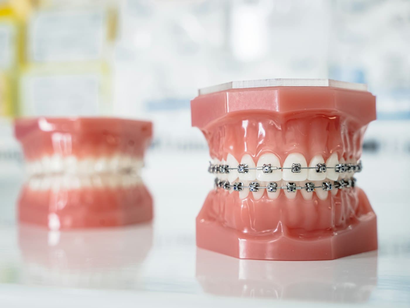Clear Aligners vs. Traditional Braces: What's the Difference?