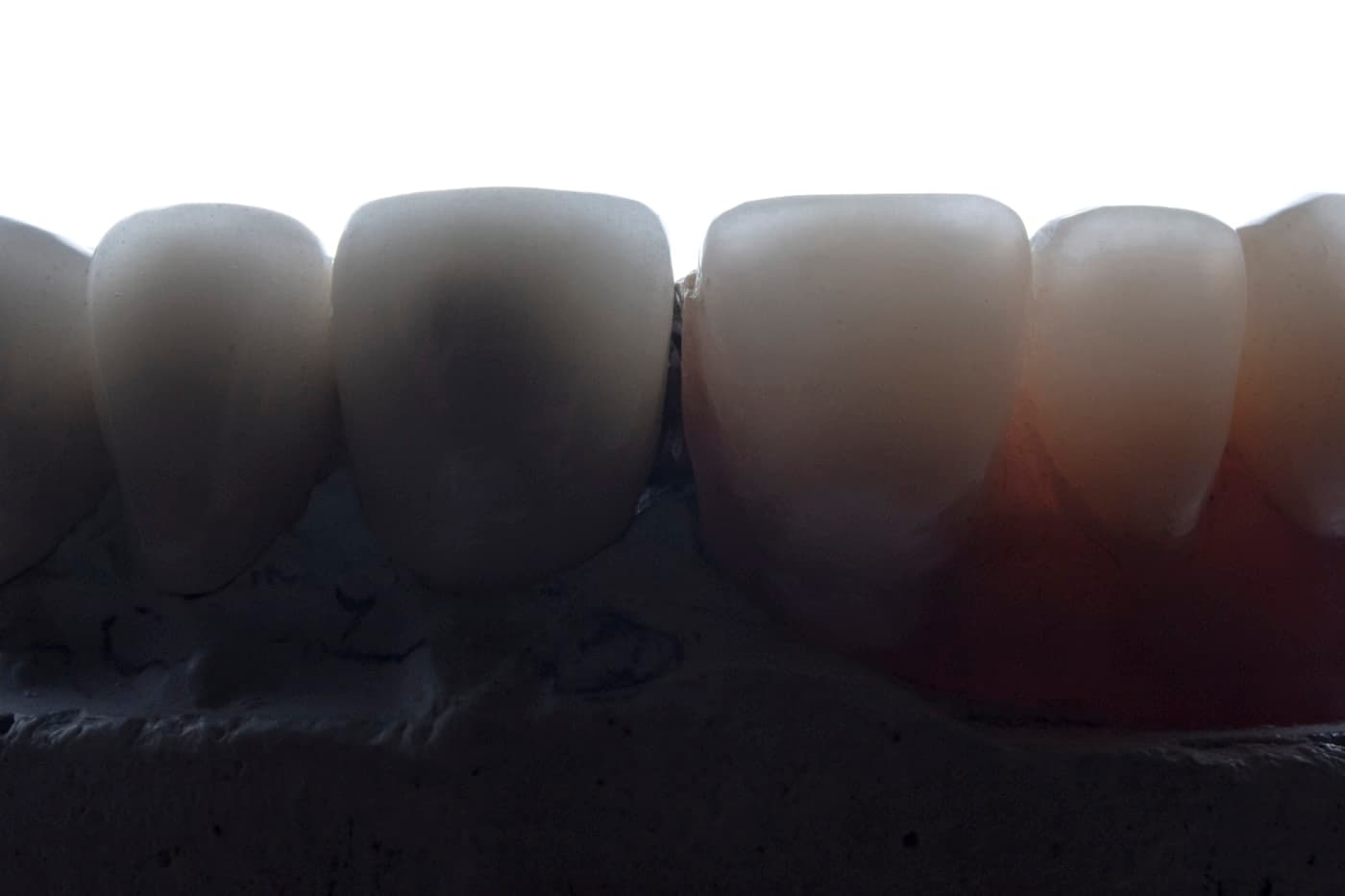 How Long Do Porcelain Veneers Actually Last?