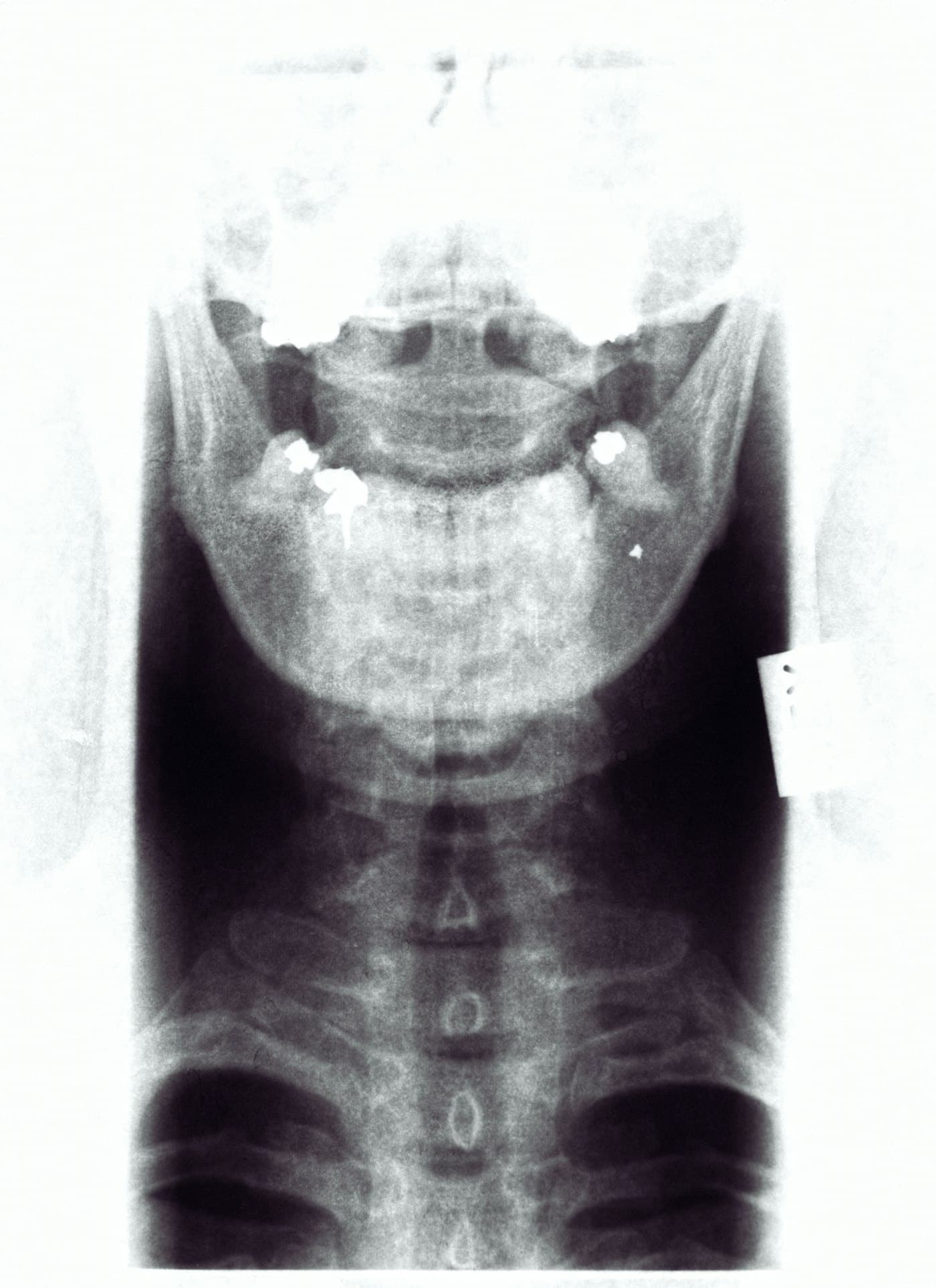 The Truth About Root Canals: Debunking Common Myths