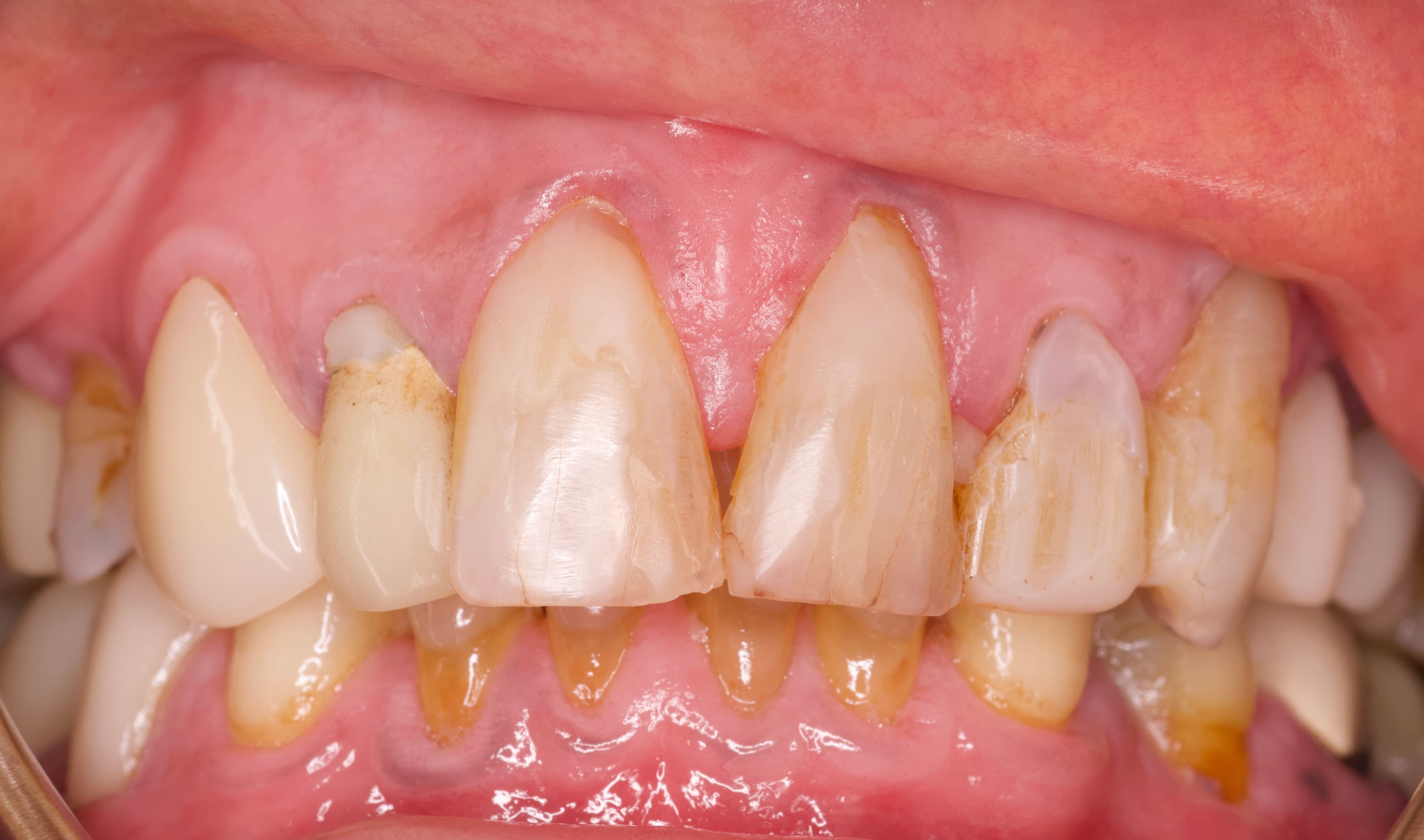 Case 01: Anterior eMax Crowns: before