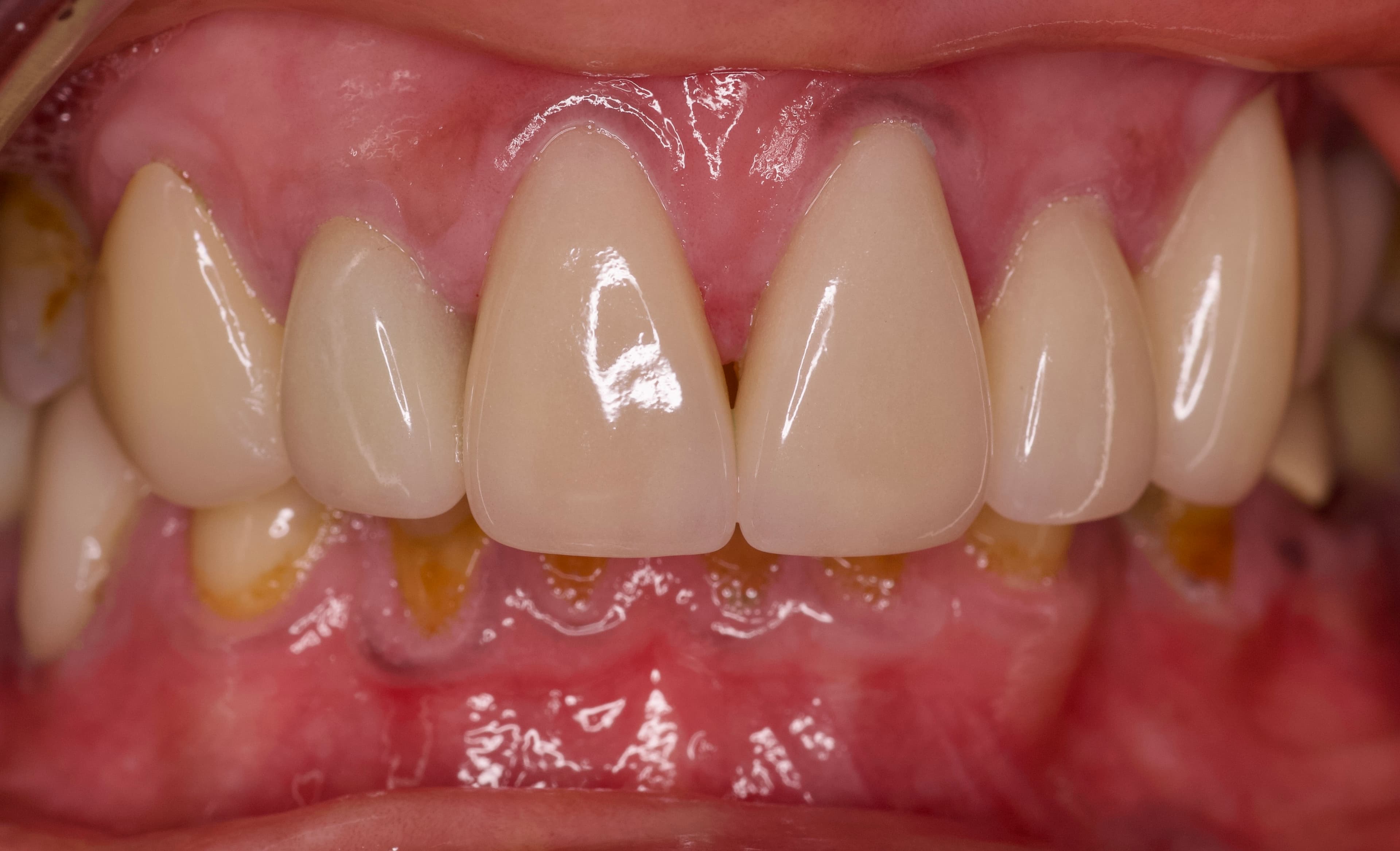 Case 01: Anterior eMax Crowns: after