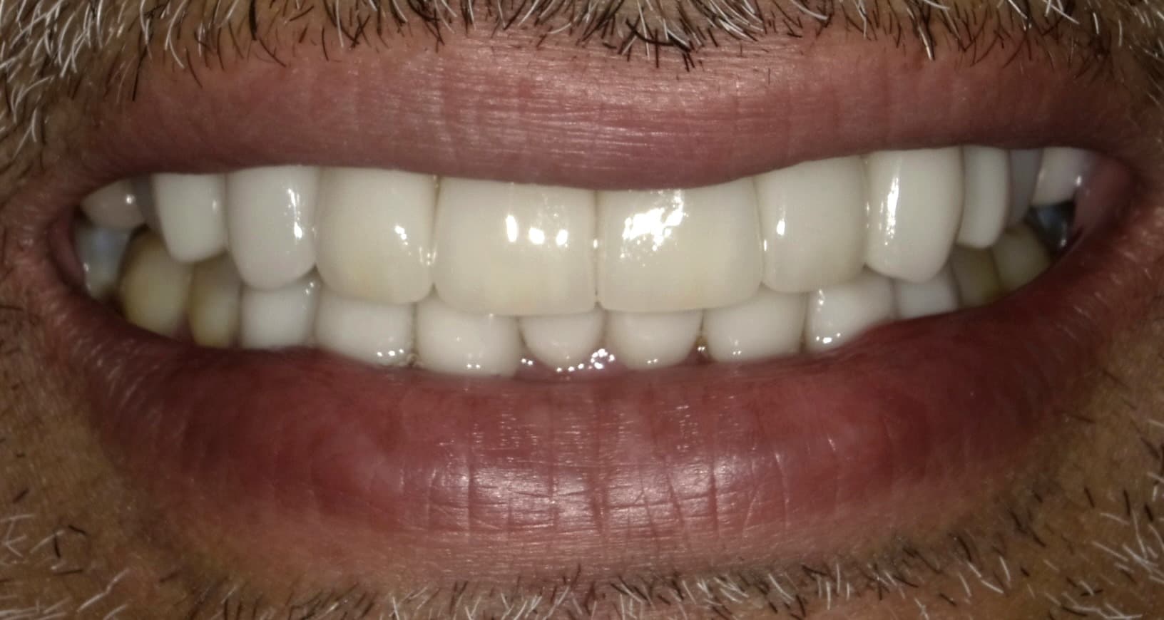 Case 02 — eMax Restorations (Shade B1) — after