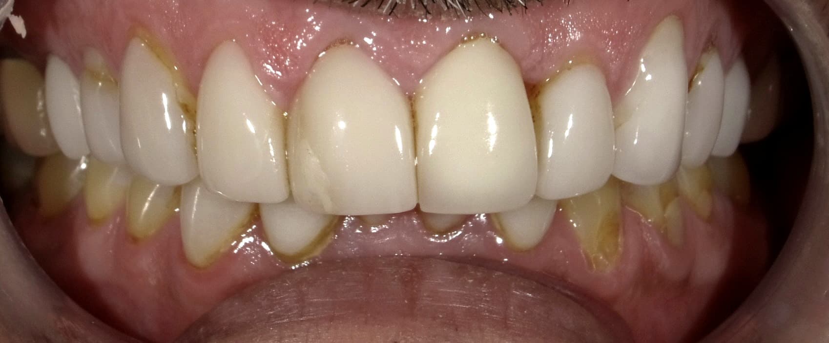 Case 02 — eMax Restorations (Shade B1) — before