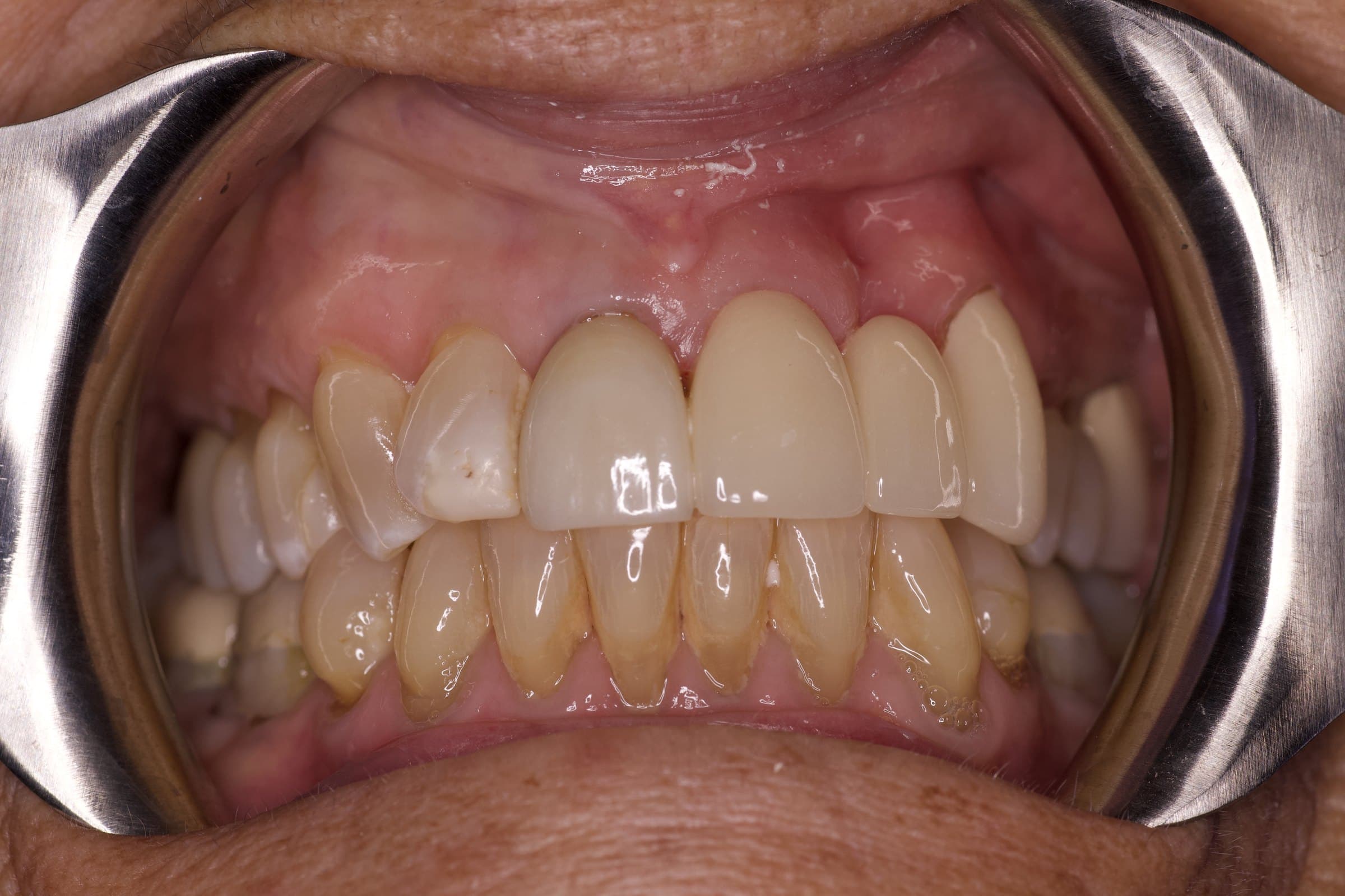 After: porcelain-fused-to-zirconia fixed bridge replacing tooth #10, matched to the neighboring front tooth #8, photographed at delivery