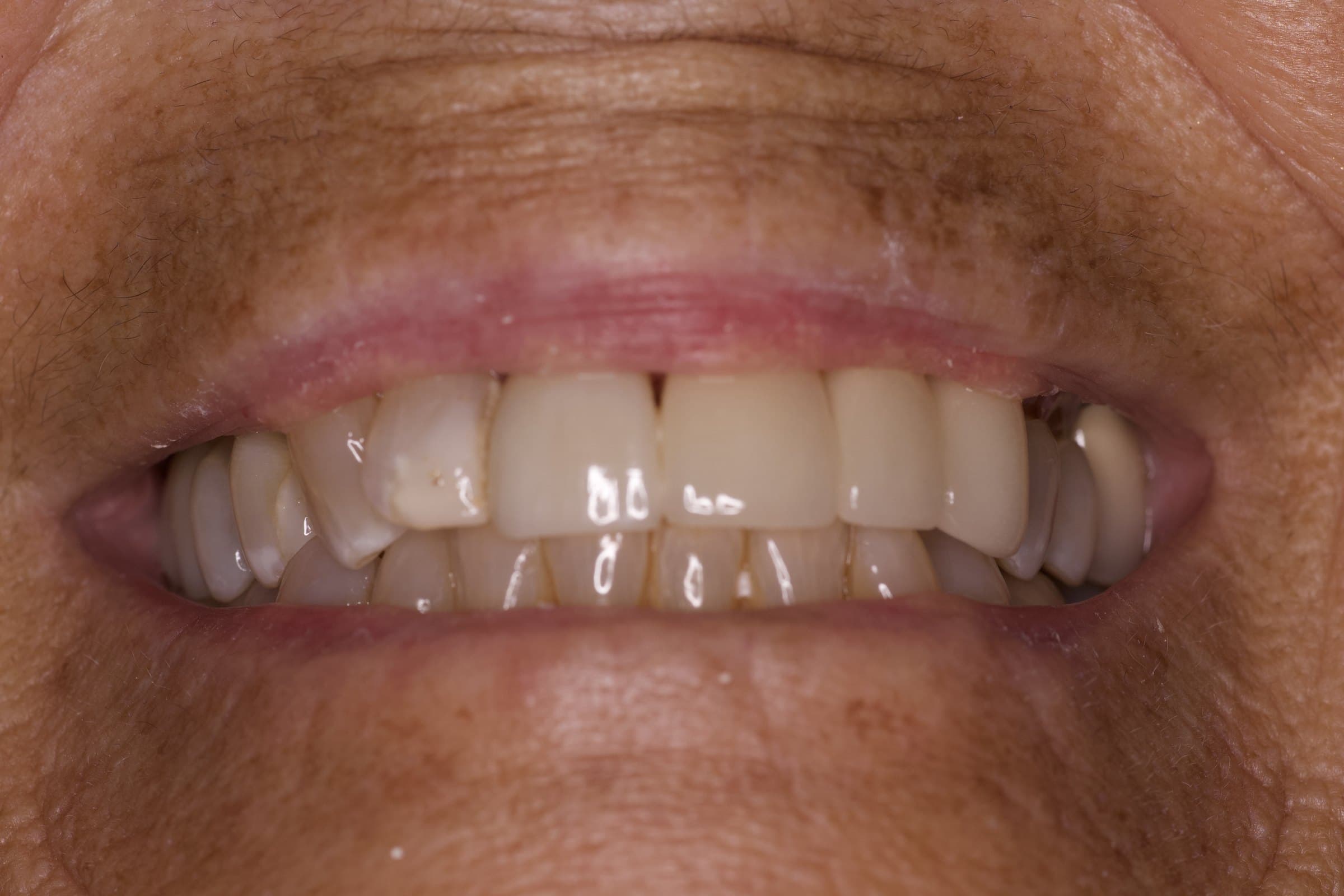 After: smile with the new porcelain-fused-to-zirconia bridge in place of tooth #10, photographed at delivery