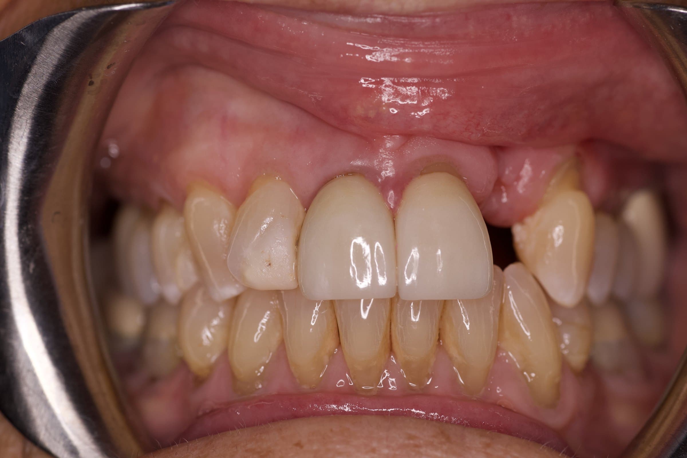 Before: gap and gum defect where upper left lateral incisor (tooth #10) was missing, next to two front crowns
