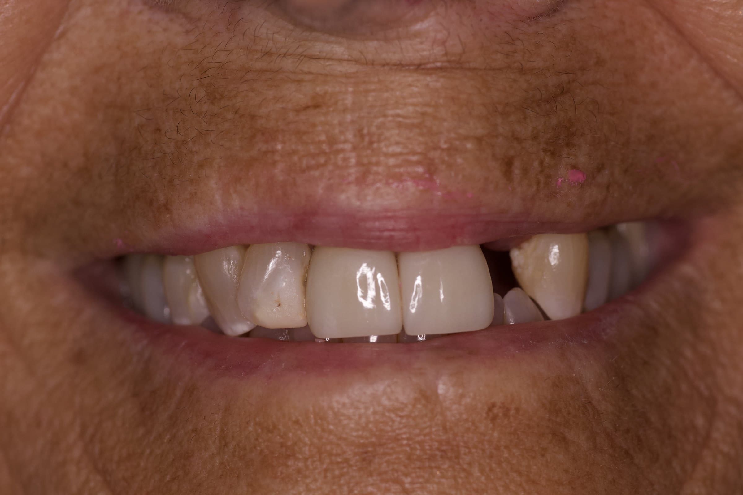 Before: smile with a visible gap where tooth #10 was missing