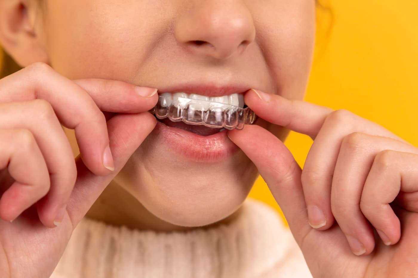 CandidPro™ Clear Aligners