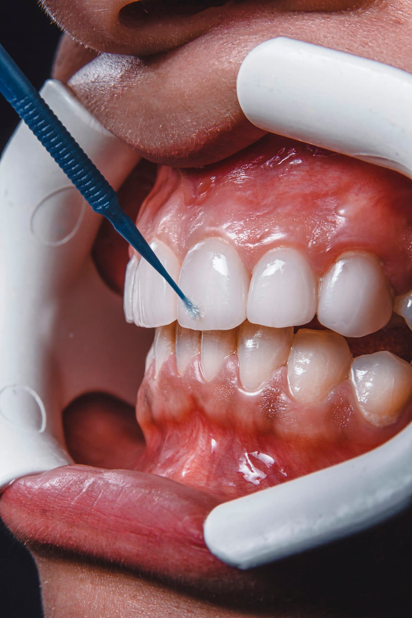 Dental Bonding