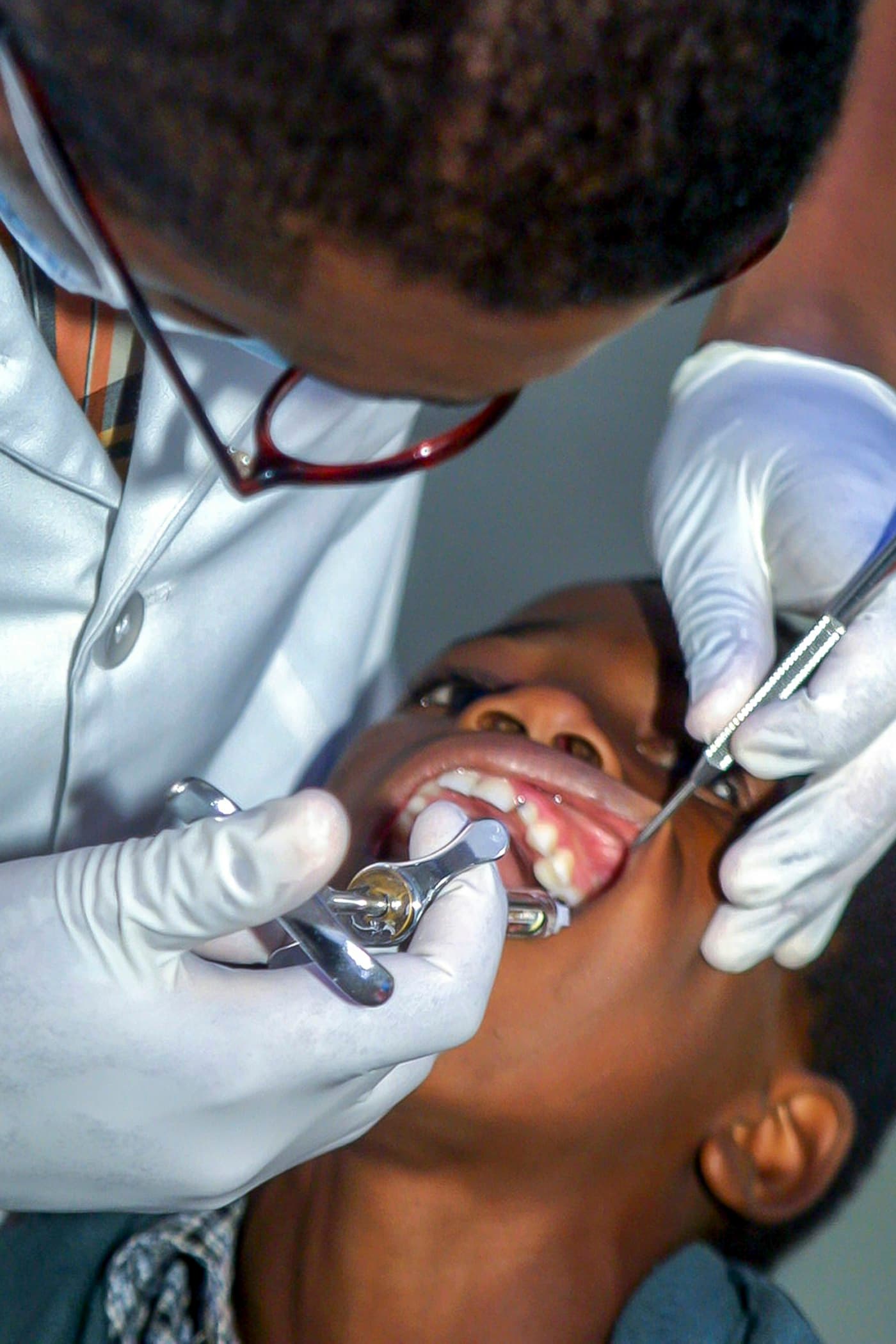 Dental Sealants