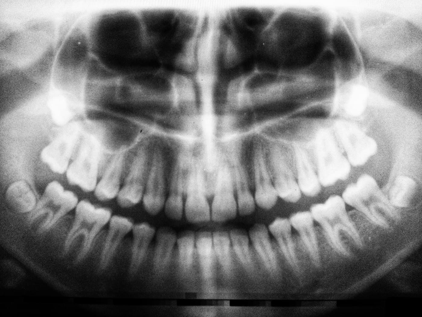 Wisdom Tooth Removal