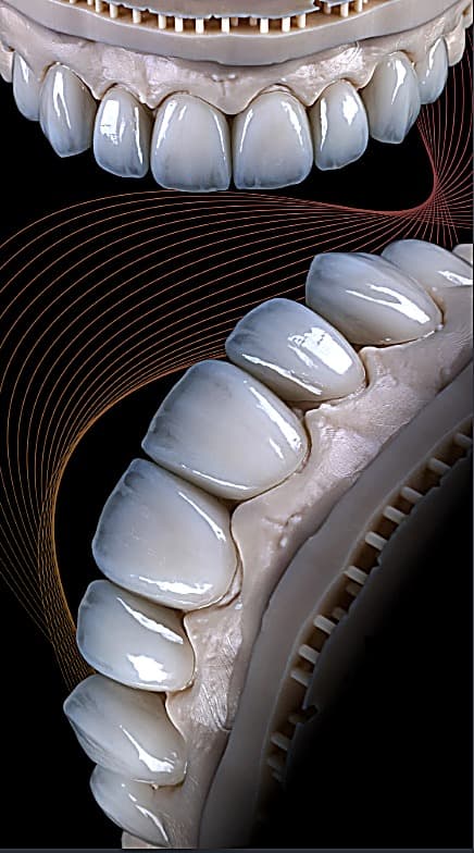 Precision-crafted porcelain veneers